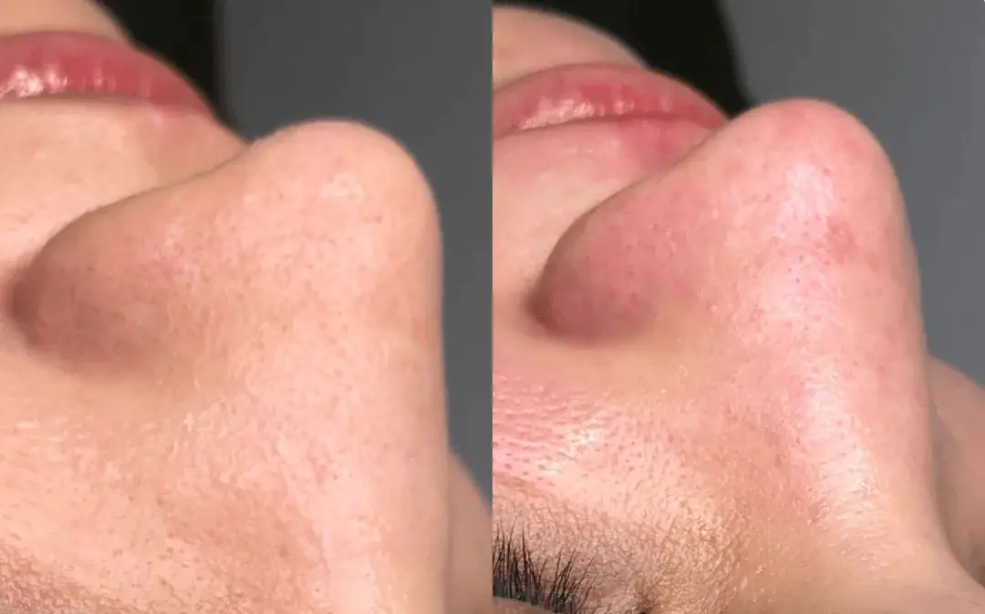 Tratamento dermatofuncional