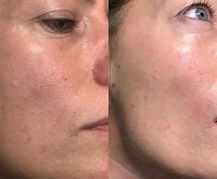 Jato de plasma antes e depois