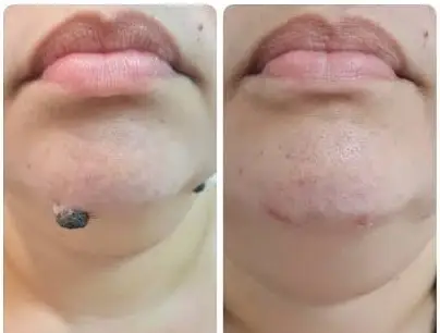 Remoção de verrugas antes e depois